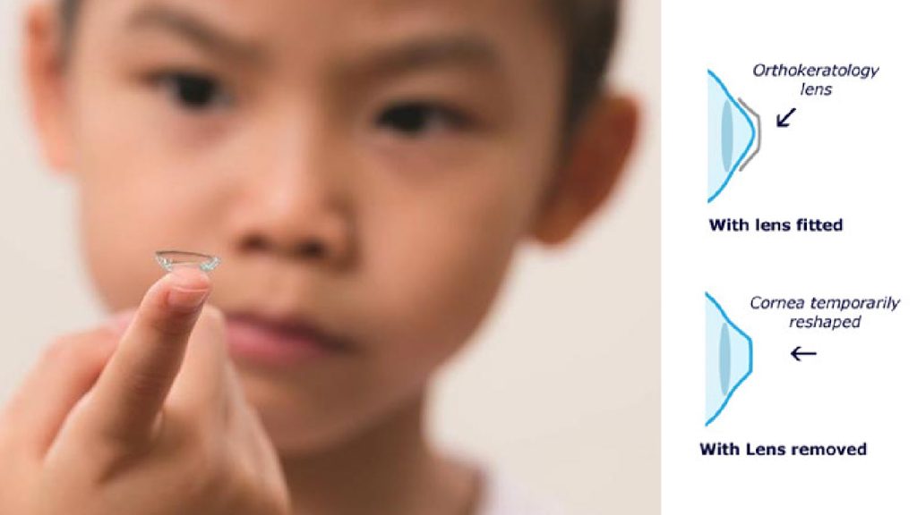 Ortho-k Myopia Control Treatment
