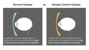 Eyeball elongation under normal glasses vs. myopia control glasses